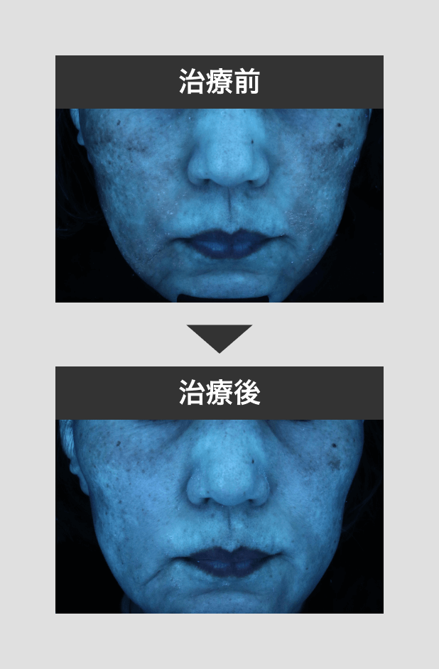 肝斑治療シミクリア