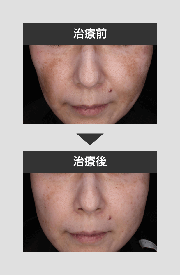肝斑治療シミクリア症例