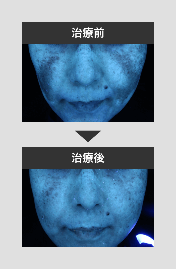 肝斑治療シミクリア症例