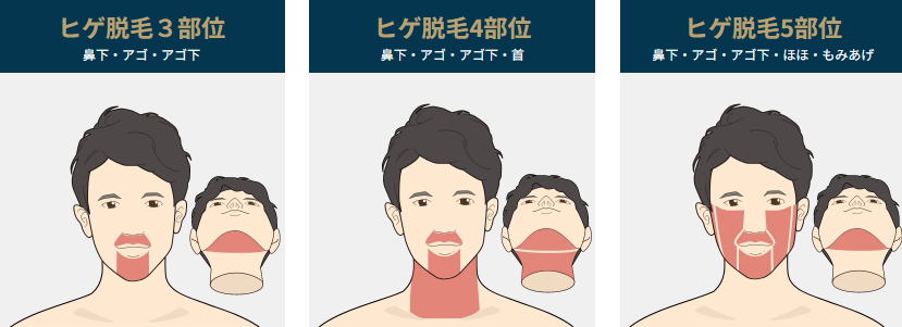 ゴリラクリニックのヒゲ脱毛・顔脱毛料金