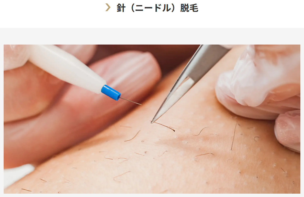 ゴリラクリニックのニードル脱毛料金