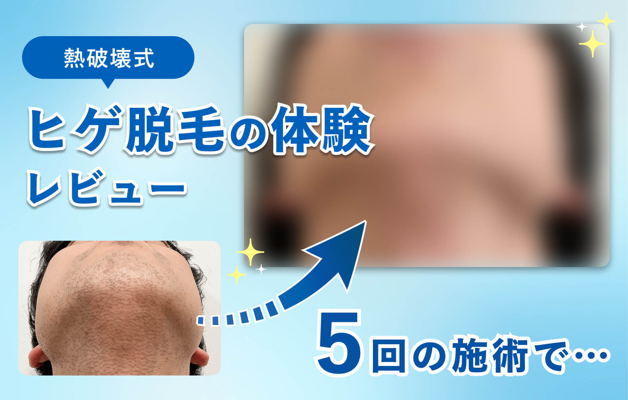 ヒゲ脱毛の体験レビューイメージ