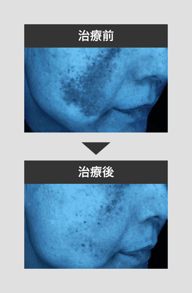 肝斑症例1ー4
