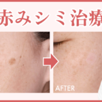 赤みシミ_MV_250920_明朝 (1)