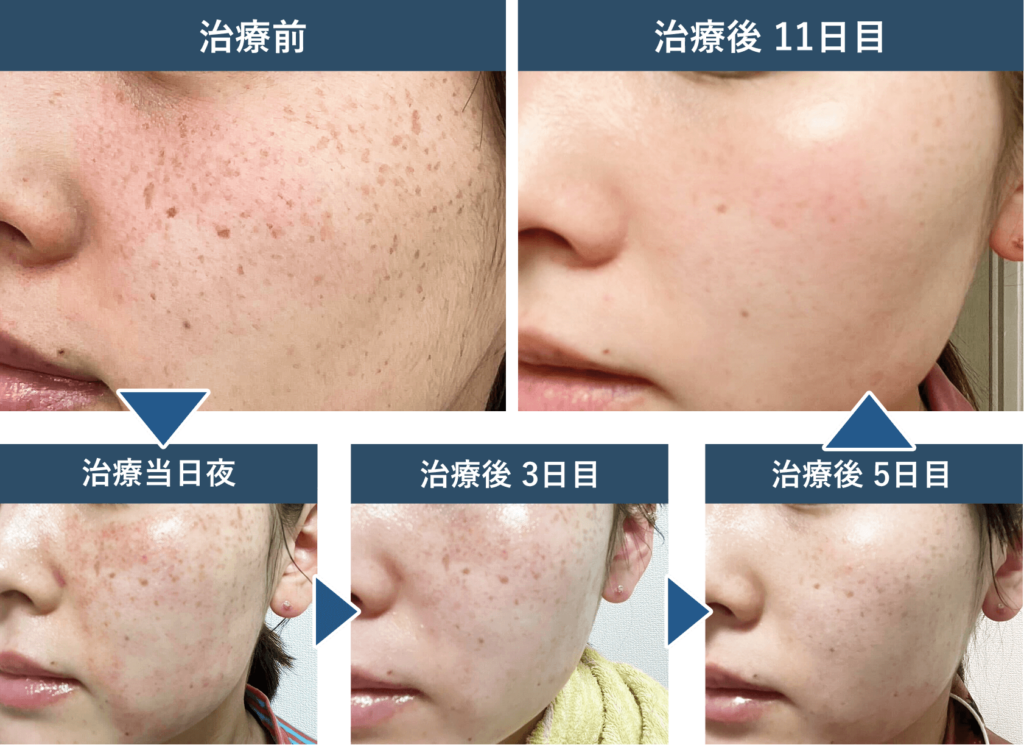 そばかす治療の症例