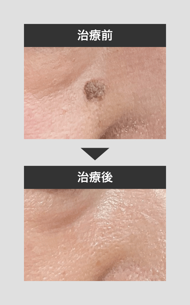顔イボ_CO2レーザー_10mm大