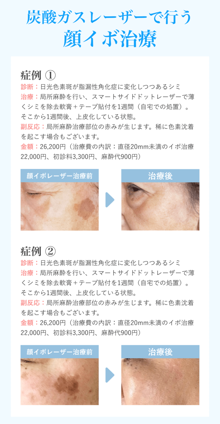 顔イボ症例修正版