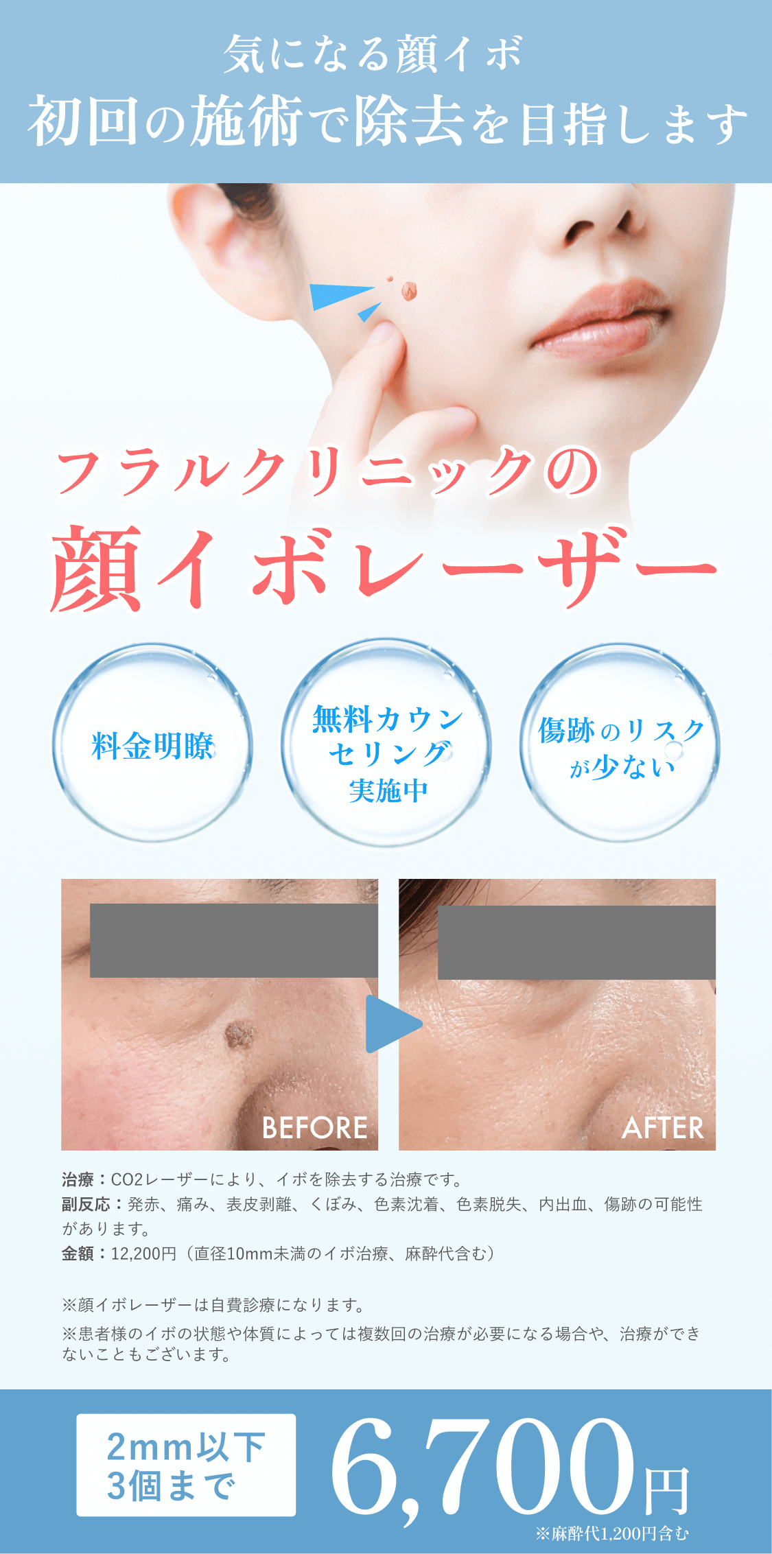 顔イボ治療 yt - 東京・大阪の美容皮膚科ならFLALU（フラルクリニック）