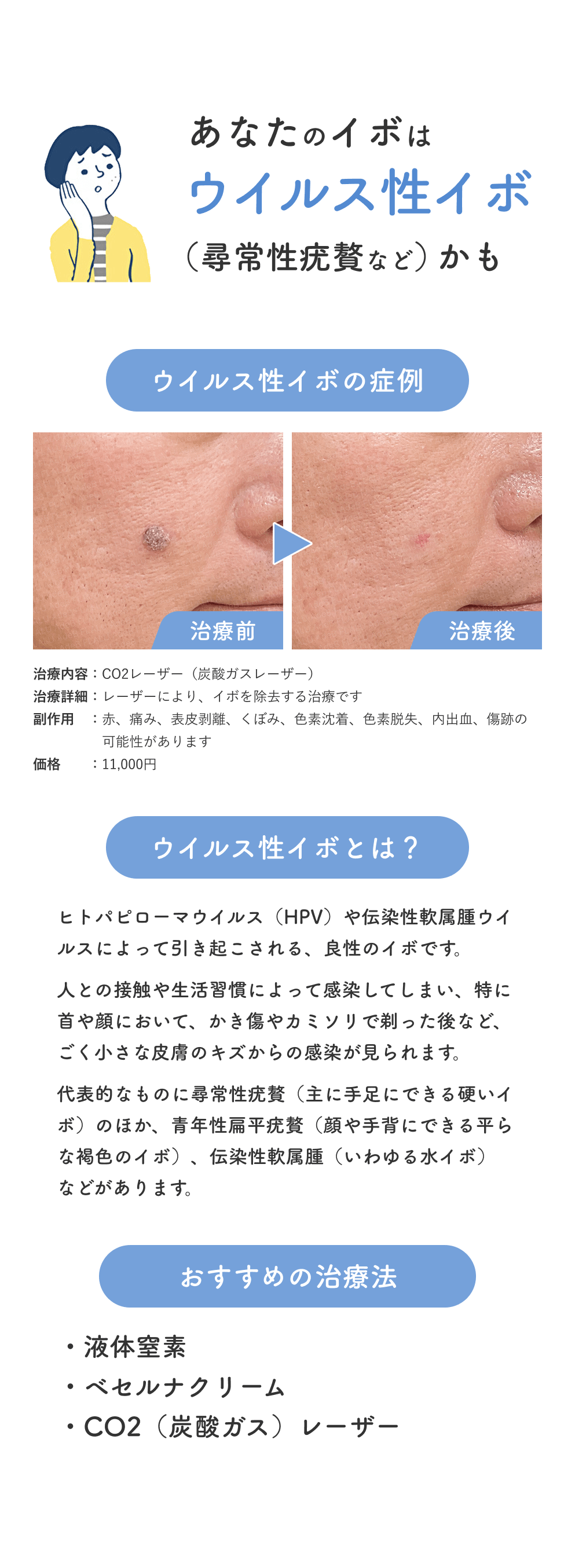 はじめてのイボ治療_POPUP_ウイルス性イボ_251101