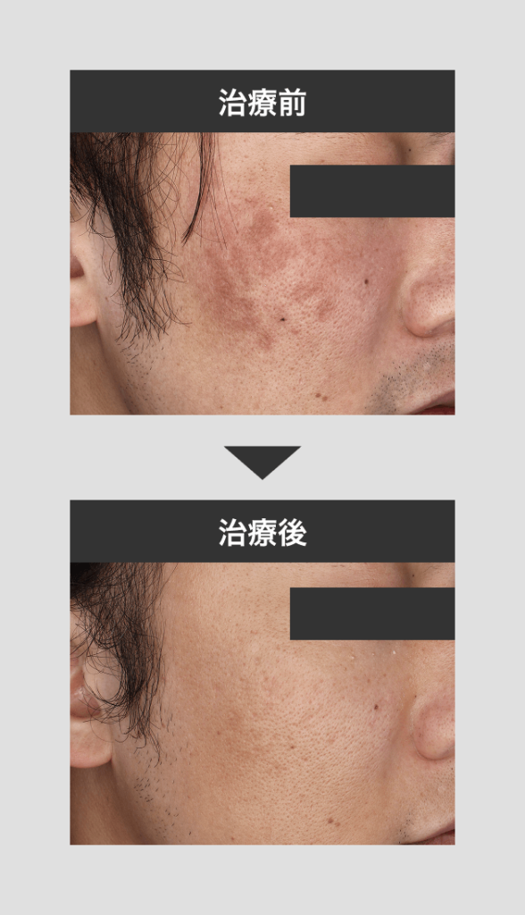 レアセラム_色沈_通常写真_目隠_251031