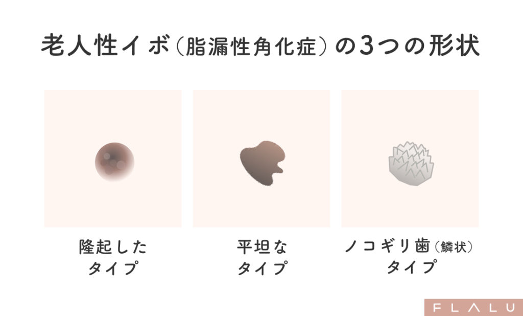 老人性イボ_形状_251106