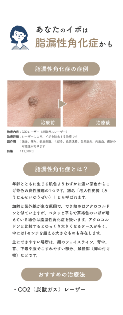 初めてのイボ治療_POPUP_脂漏性角化症_251101 (1)