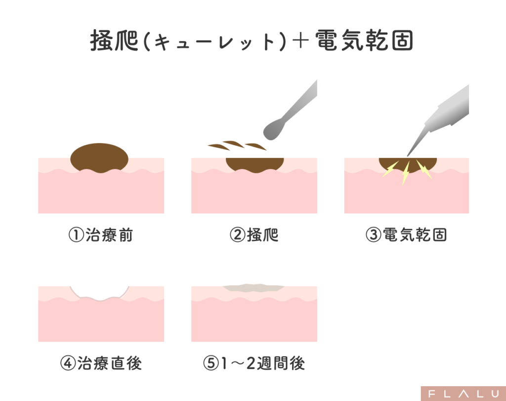 老人性イボ_治療法_キューレット+電気凝固