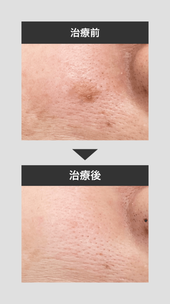 顔イボ_10mm未満症例