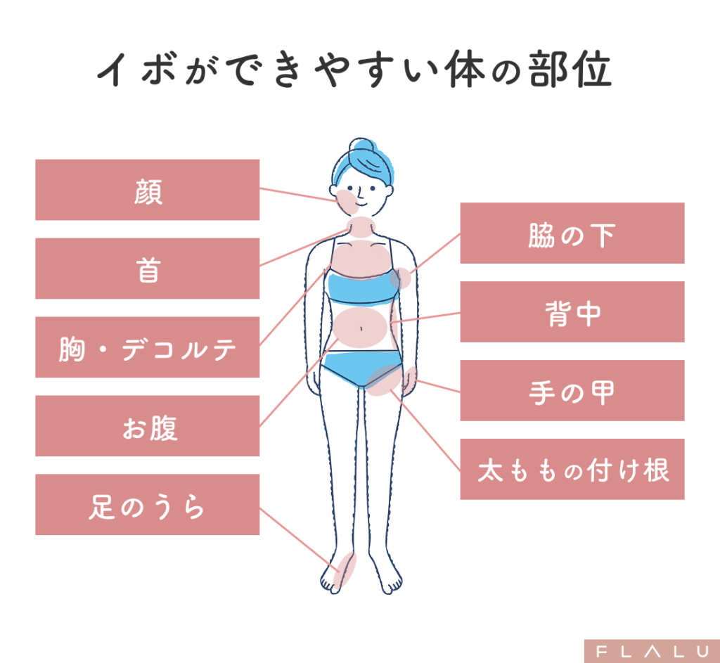 老人性イボ_できやすい部位_251106