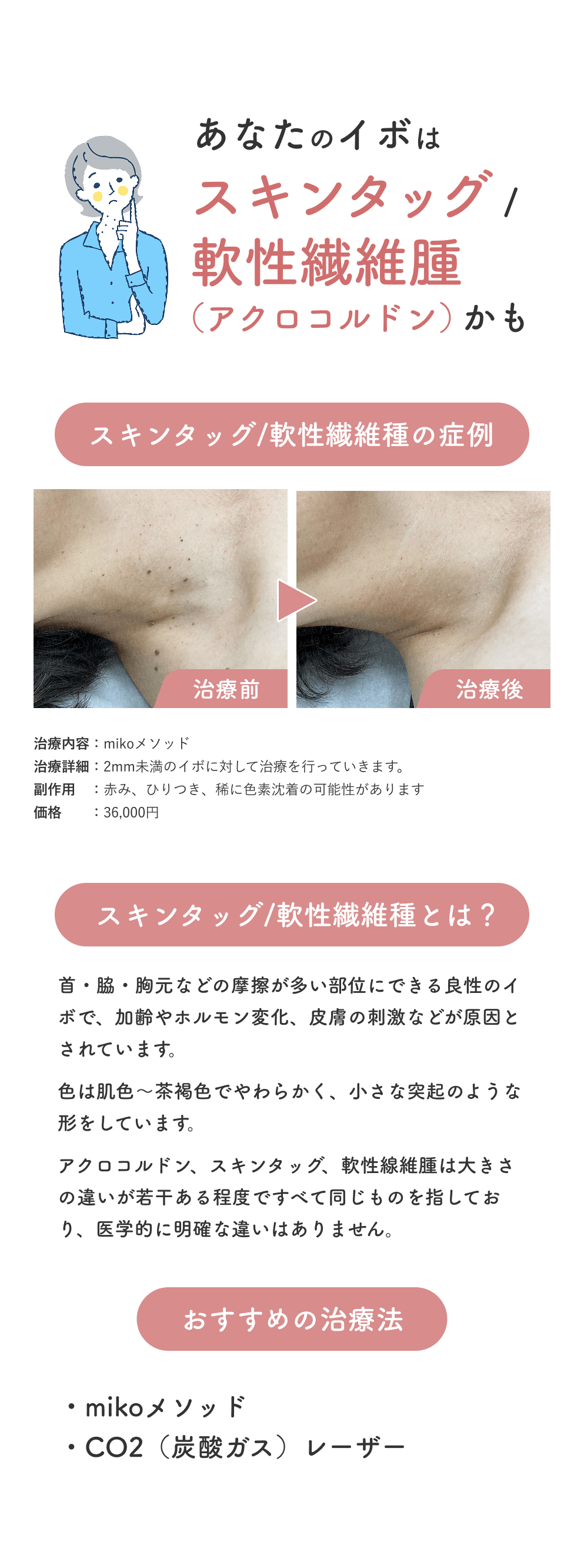 はじめてのイボ治療_POPUP_スキンタッグ_251101