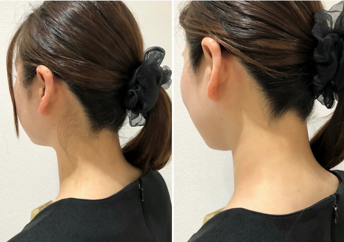 ルシアクリニック うなじ