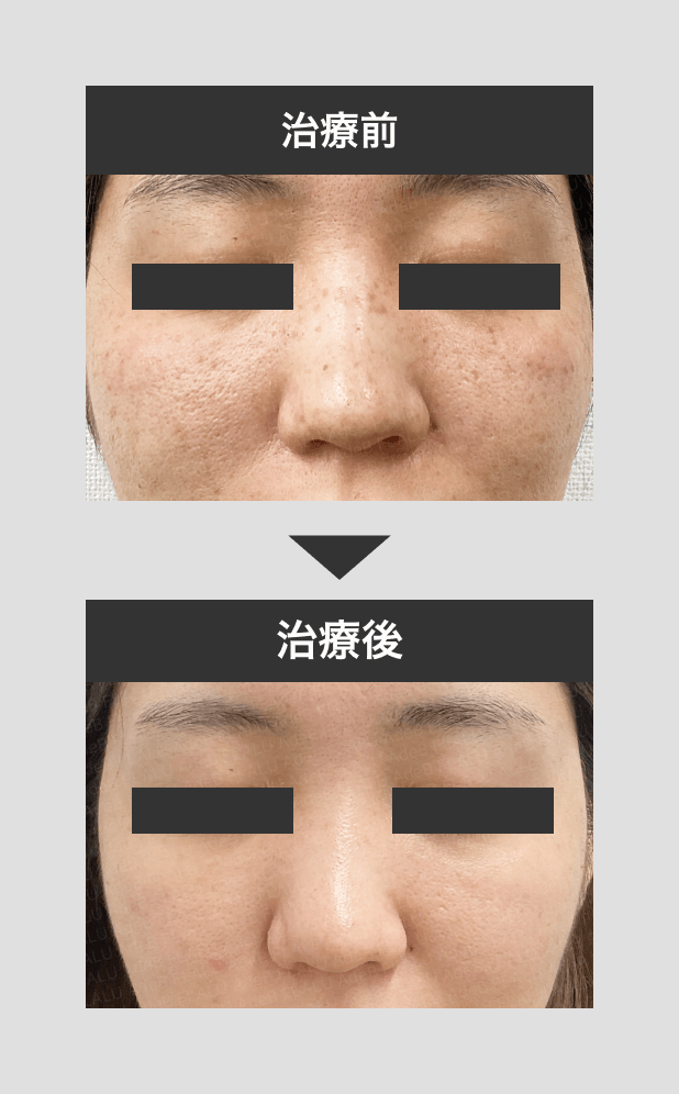 そばかすモニター_シャワー3回スポット2回