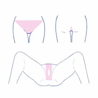 フレイアクリニックのVIOデザイン例