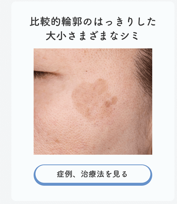 大小さまざまなシミ