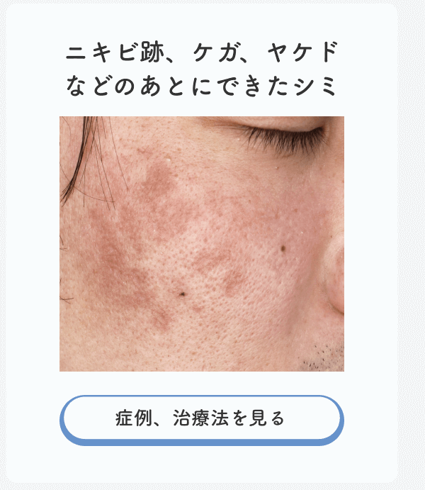 ニキビ跡、ケガ、やけどのあとにできたシミ
