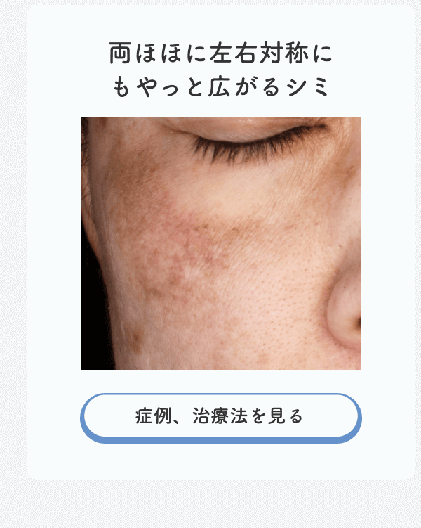 両ほほに広がるシミ