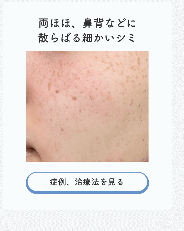 散らばる細かいシミ