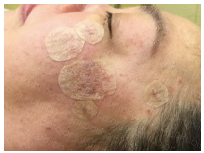 顔イボ治療直後