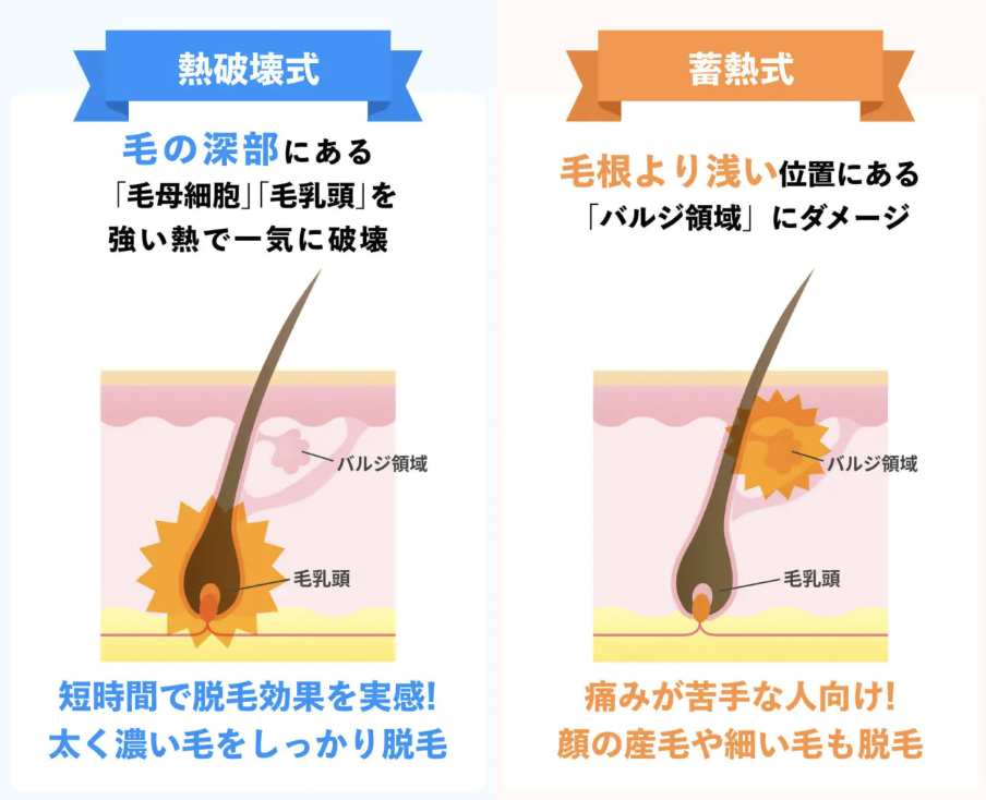 脱毛方式_熱破壊式と蓄熱式