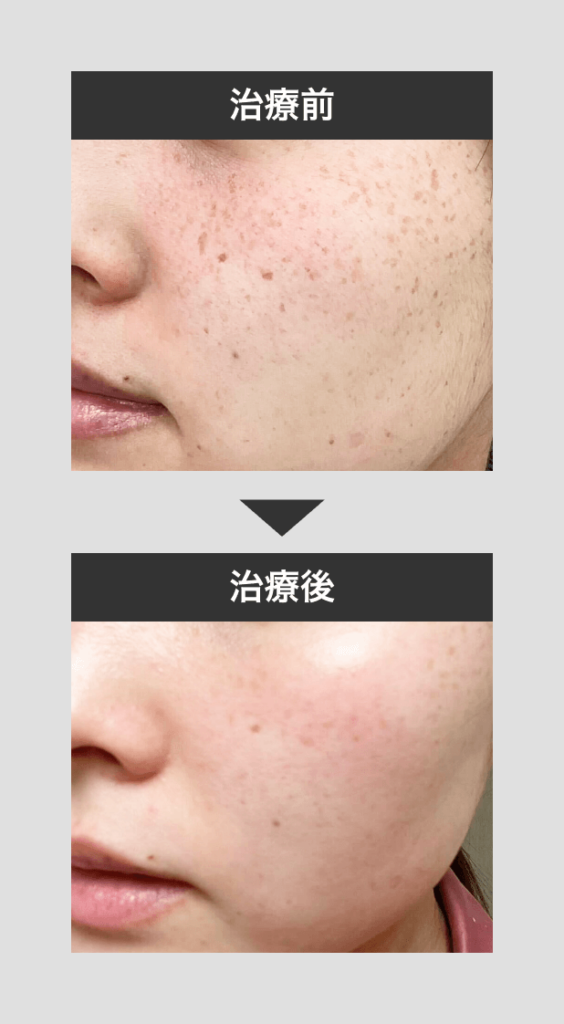 そばかす治療_ピコFx