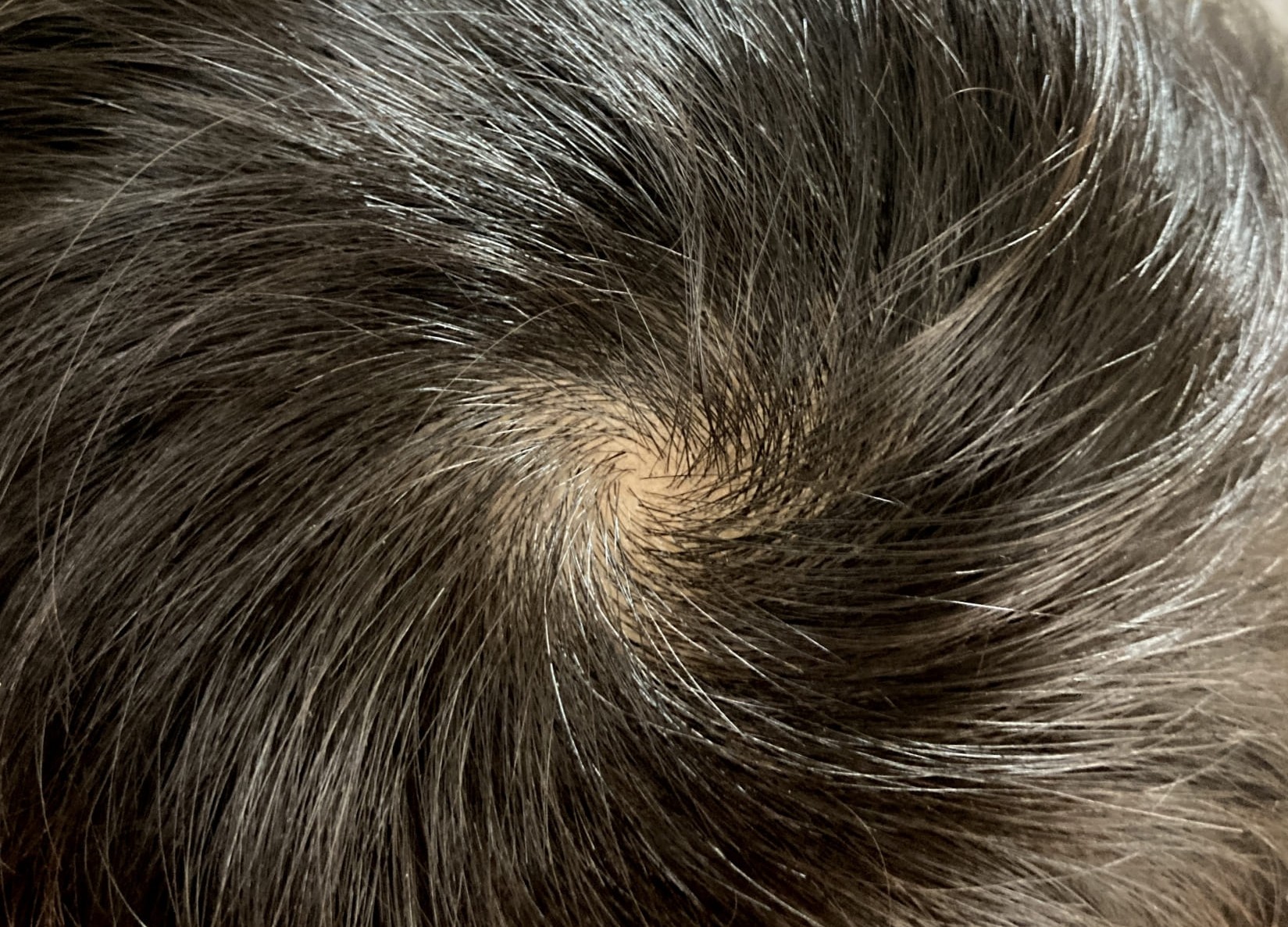 正常なつむじのイメージ