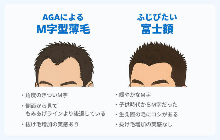 AGAによるM字ハゲと富士額の違いイメージ