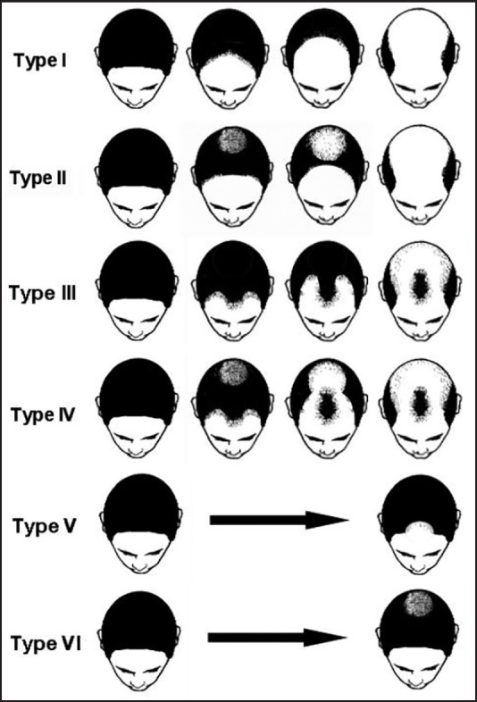 AGAの分類（緒方分類）イメージ