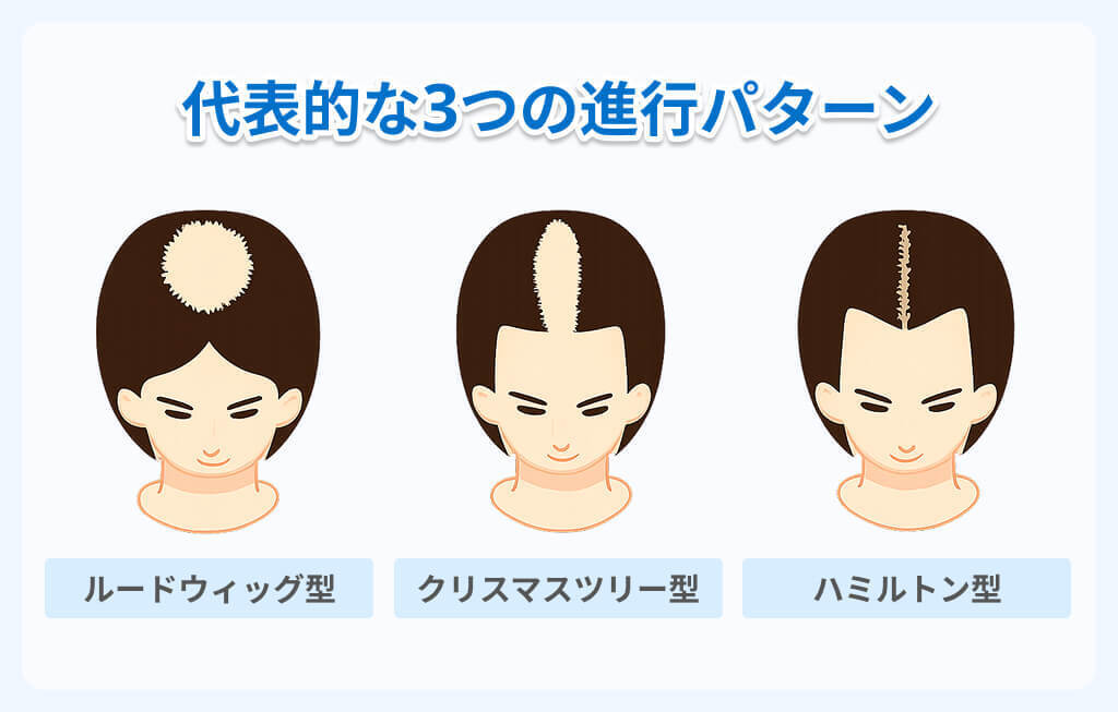 女性の薄毛「FAGA」の症状と3つの進行パターンイメージ