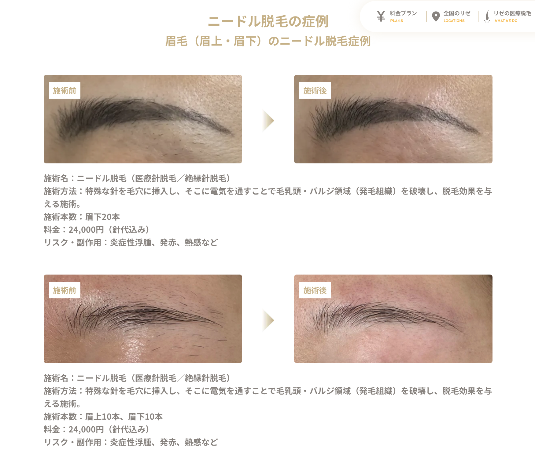 リゼクリニック ニードル脱毛症例