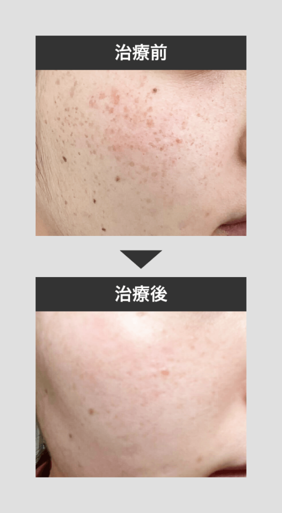 そばかす治療_ピコスポット
