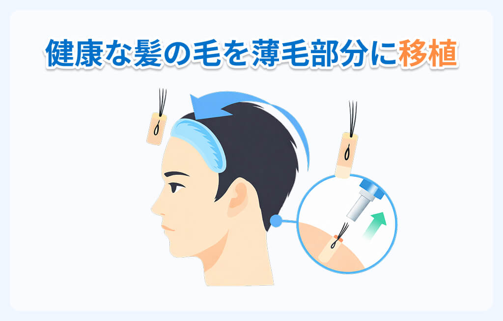 自毛植毛の仕組みイメージ
