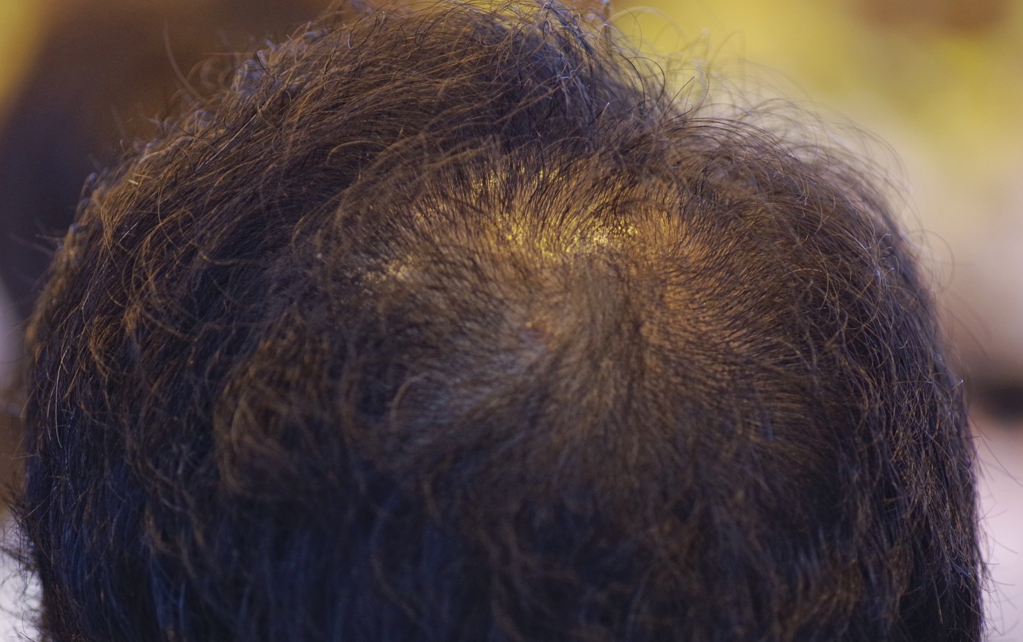 AGAによるつむじハゲのイメージ