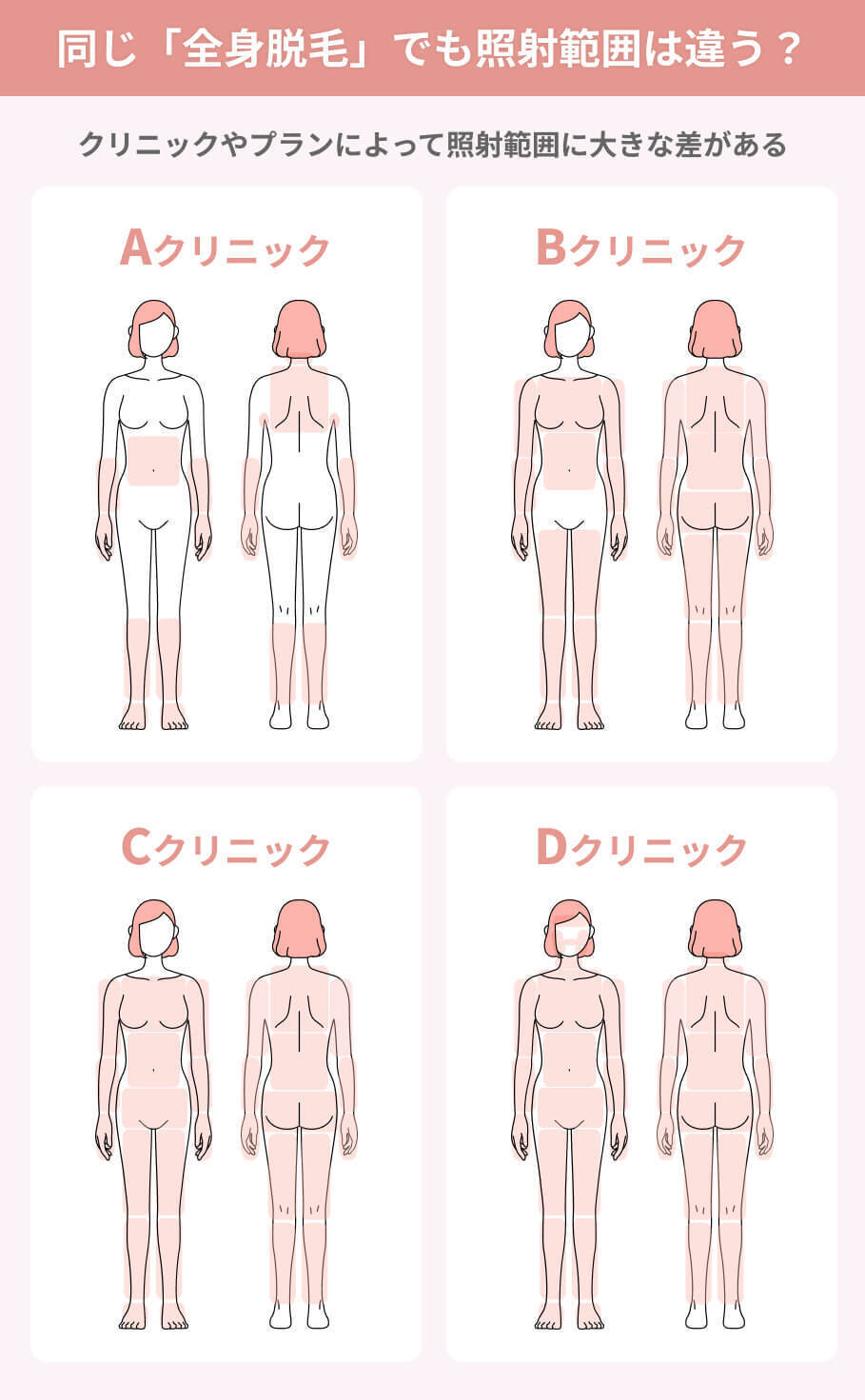 脱毛の照射範囲の違い