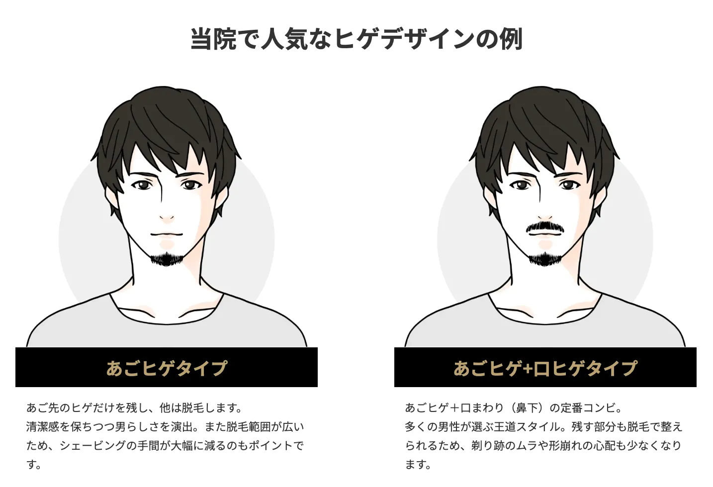 ゴリラクリニックのヒゲデザイン脱毛