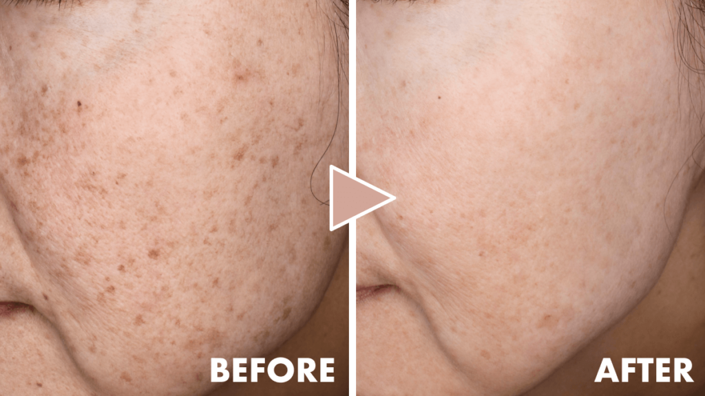 赤み混じりの肌のビフォーアフター