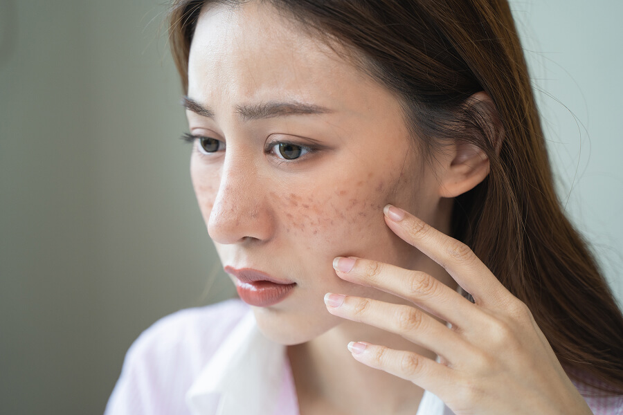 そばかすができる原因と悪化させる要因 1