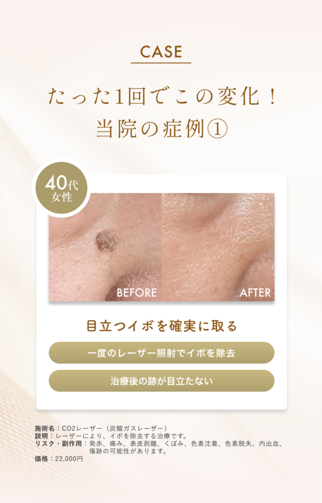 顔イボリスティング症例１