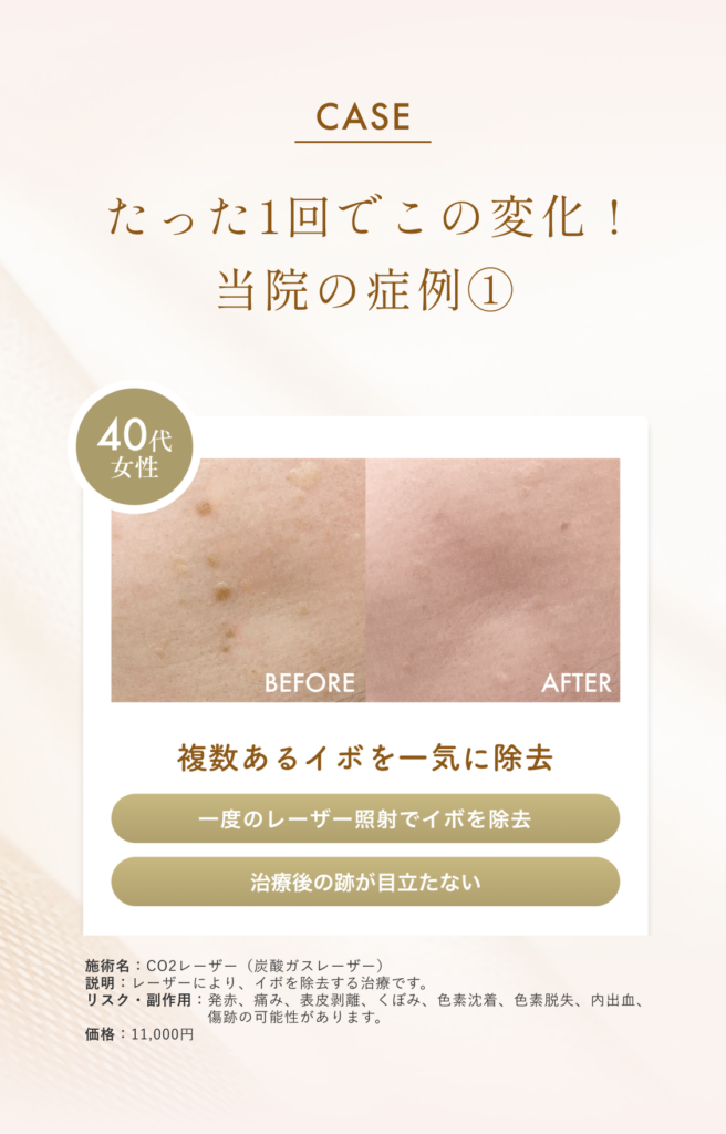 顔イボリスティング症例3