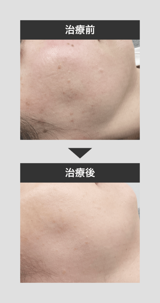 顔イボ_症例2_251225