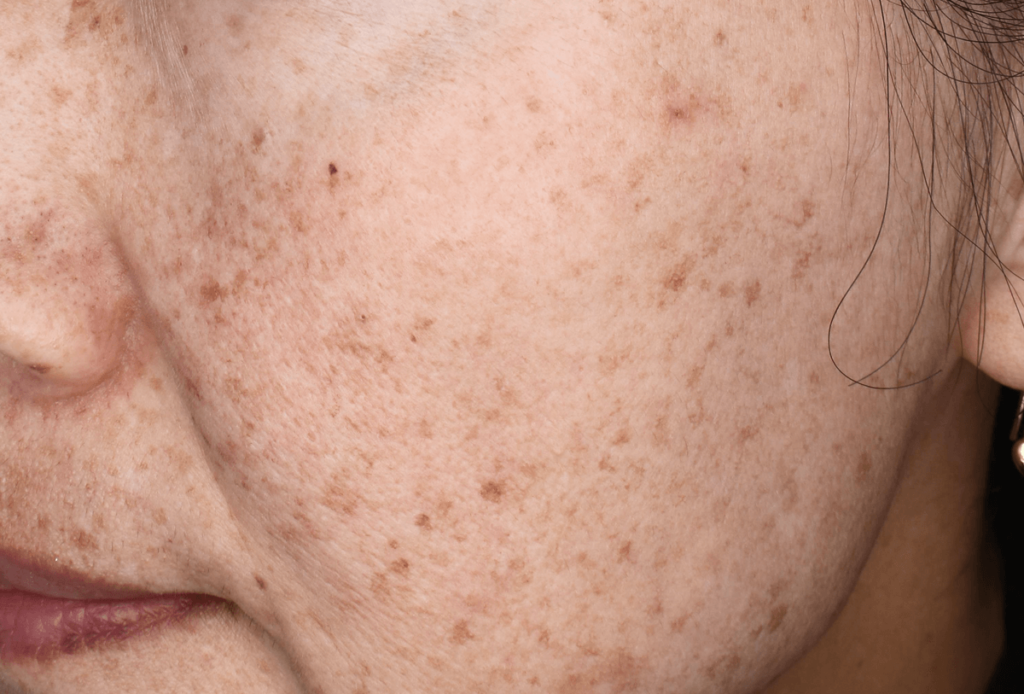 赤み混じりの肌