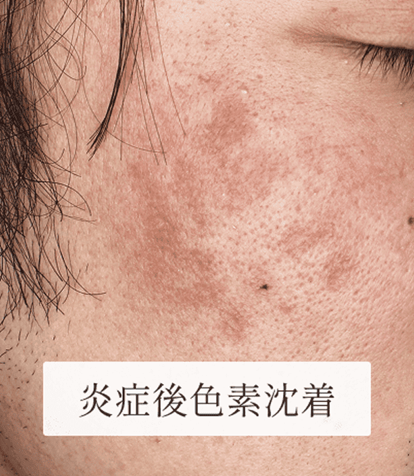 炎症後色素沈着