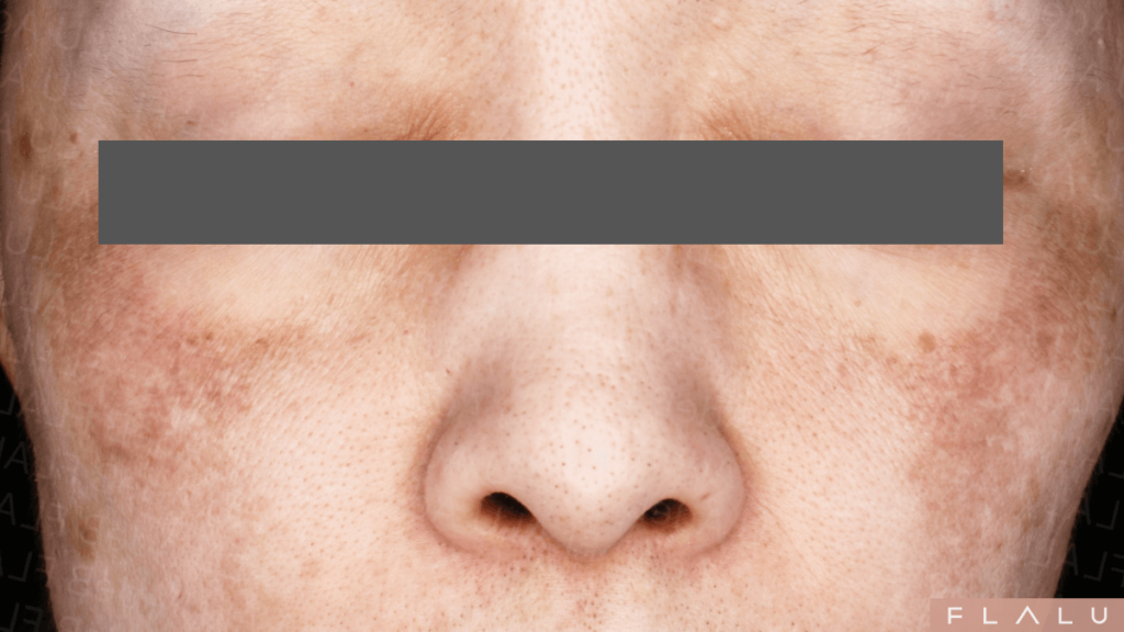 肝斑記事_両頬に広がる肝斑