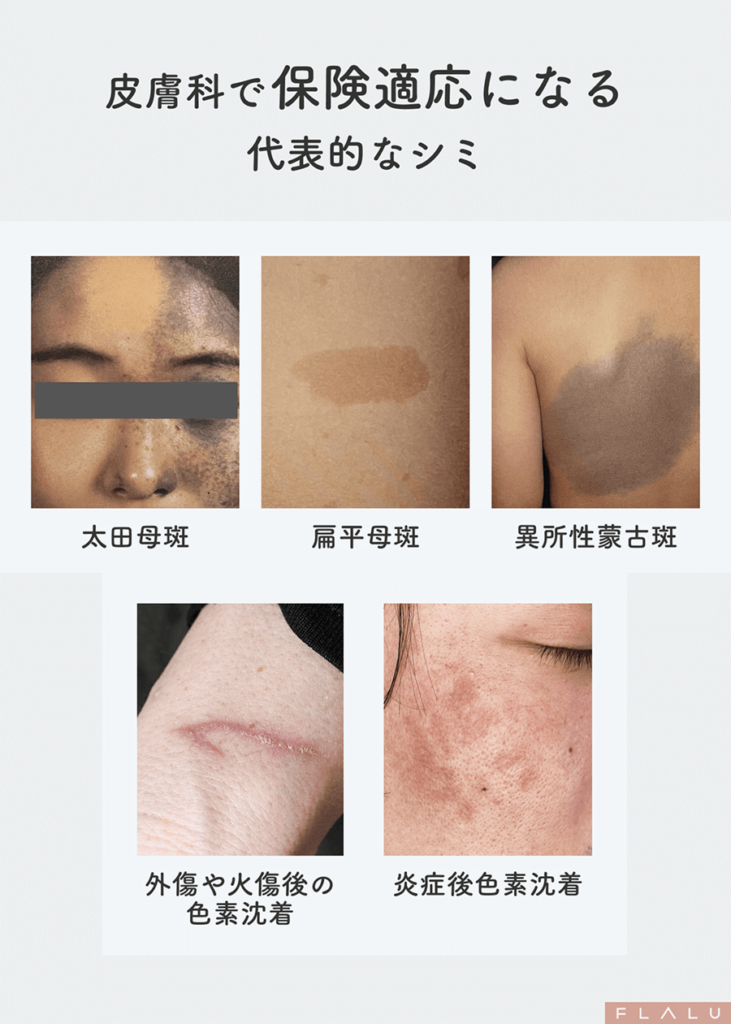 5_シミ一覧_保険適応になる 1