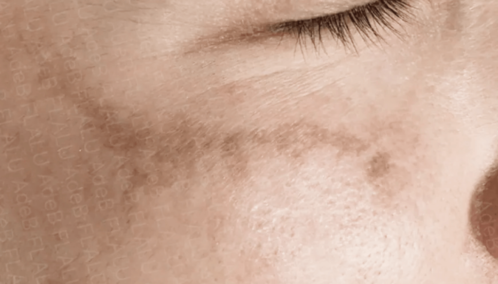 肝斑記事_肝斑症例_回転